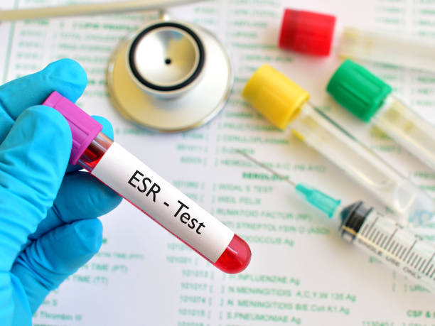 Erythrocytes Sedimentation Rate