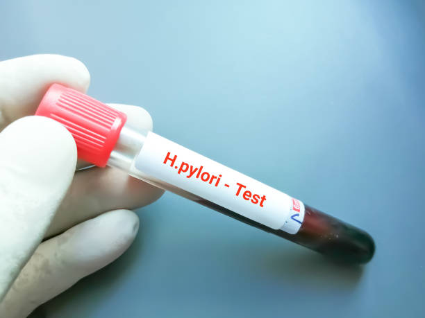 Helicobacter pylori stool Antigen (Hp. S. Ag.)