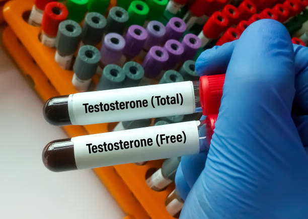 Testosterone total